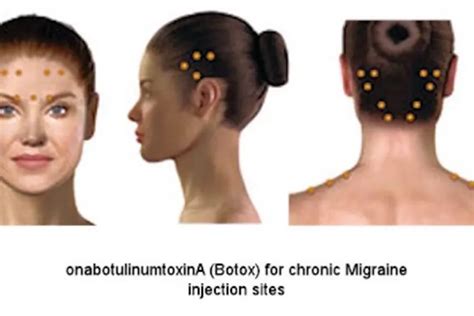 Botox for Chronic Migraine: Knowledge of Anatomy Is Critical