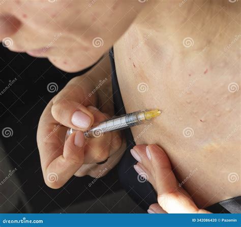 Woman Performing Mesotherapy, Bio Revitalization Procedure, Injecting
