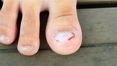 Do You Frequently Get Toenail Fungus? Here's How You Can Prevent It | OnlyMyHealth