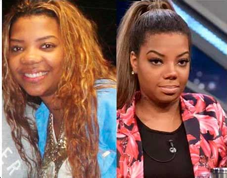Ludmilla Antes E Depois Cirurgia - Cirurgias Plásticas da cantora Ludmilla | Antes e Depois da Ludmilla ...