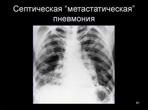 Рентгенодиагностика пневмоний - презентация онлайн