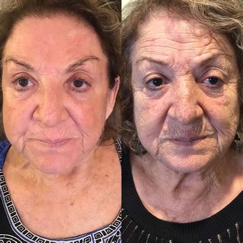 All About Phenol Peel: Is It Worth It? Risks & Results | Phenol peel ...