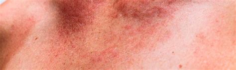 Complete Guide On Stds That Cause Skin Rash On Body G - vrogue.co