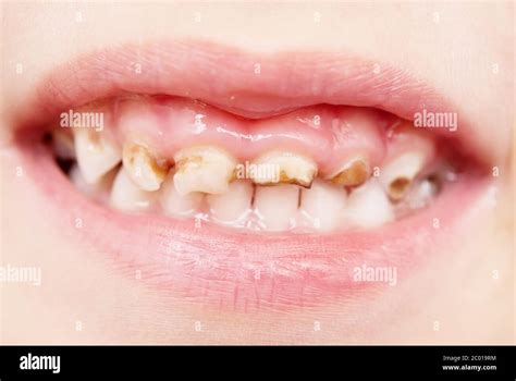 bad teeth  res stock photography  images alamy