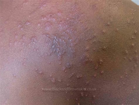 Urticaria/Hives — Black & brown skin