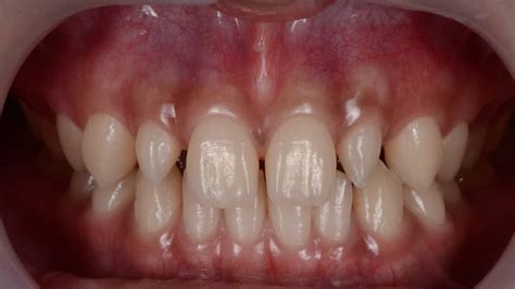 treatment options  peg shaped teeth