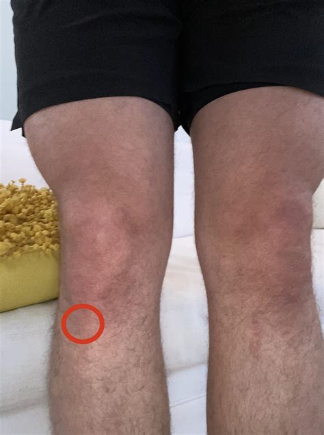Bone-like bump at this location on my right knee - anyone know what