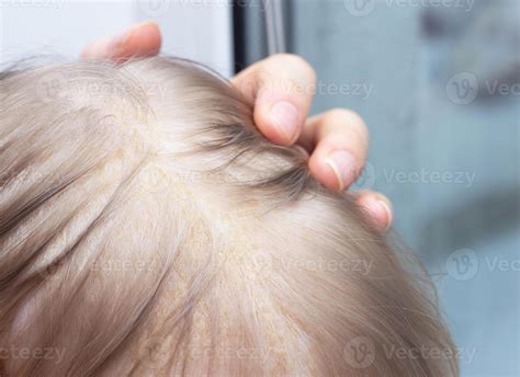 Fungal skin disease seborrheic dermatitis in a child's head, close-up