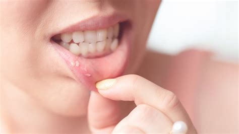 Canker Sores Treatment