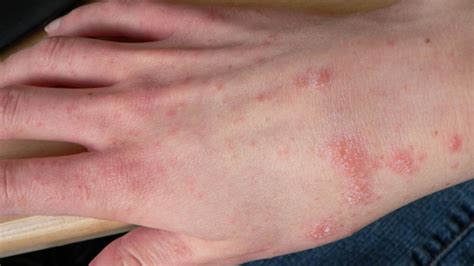 National action plan must stop the rapid advance of scabies - TIme News