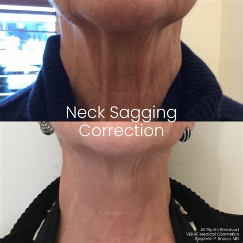 how to fix sagging neck