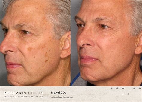 laser treatment
