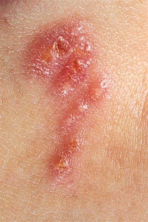 Herpes Sore Groin at Melvin Jackson blog