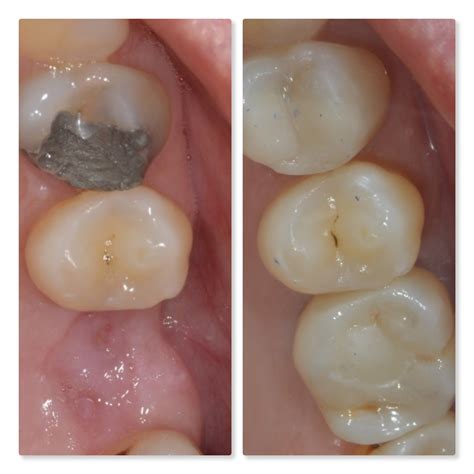 Old Tooth Fillings And Mri at Eloise Rameriz blog