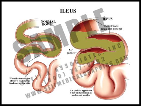 Ileus - S&A Medical Graphics