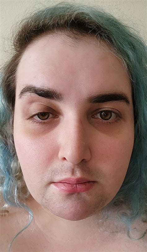 Two Months Post Op FFS : r/Transgender_Surgeries
