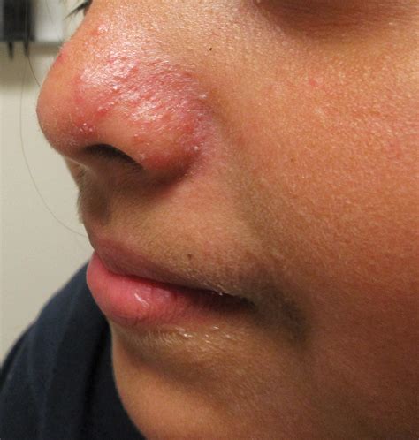 Erythematous Papules and Pustules on the Nose | MDedge