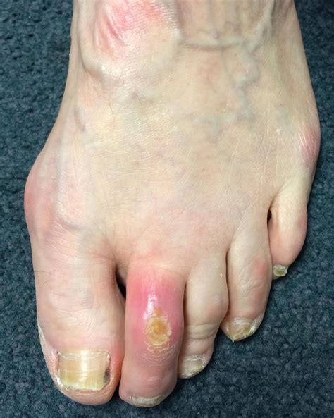 Claw Toe | Claw Toe Deformity | LFAC