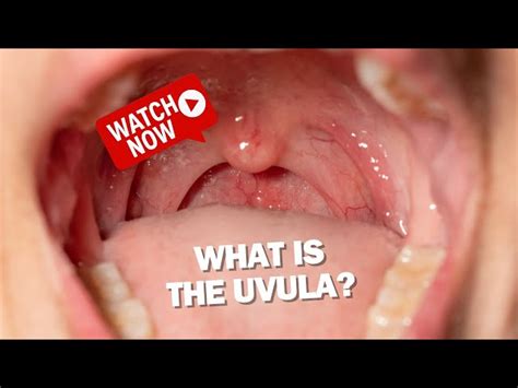 enlarged uvula