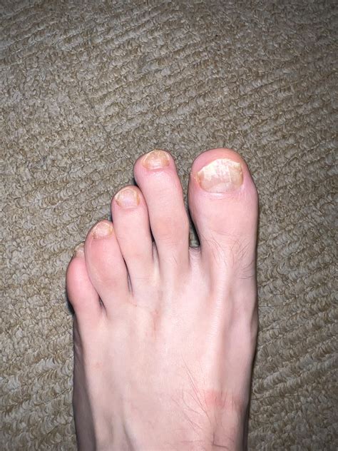 Is this fungus and how do i treat it? : r/NailFungus