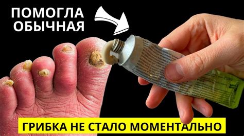 Эта ДОСТУПНАЯ ЯДРЁНАЯ Советская Мазь Разъест Весь Грибок с Ногтей ...