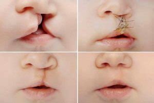 Cirurgia De Labio Leporino - Lábio leporino: fotos antes e depois