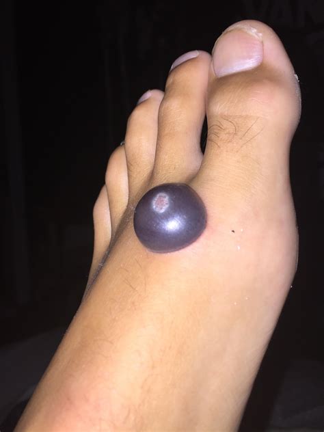 What Happens If You Pop A Wart Blister at Kenneth Keene blog