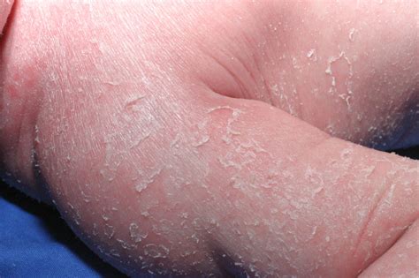 bullous congenital ichthyosiform erythroderma  differential