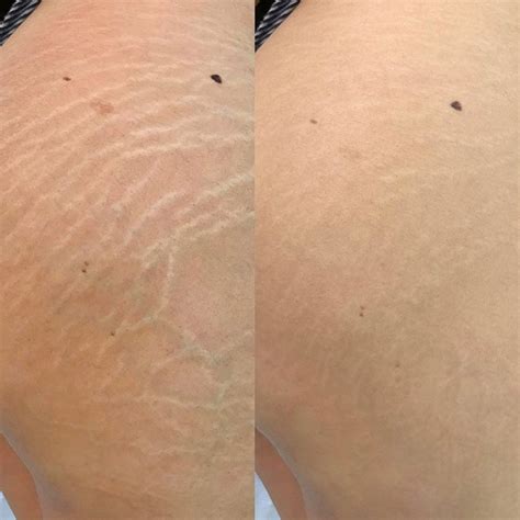 Camuflagem De Estrias Antes E Depois - Camuflagem de estrias: Como é feito e o Antes e depois