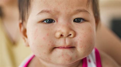dengue symptoms rash large discounts wwwoceanpropertycoth