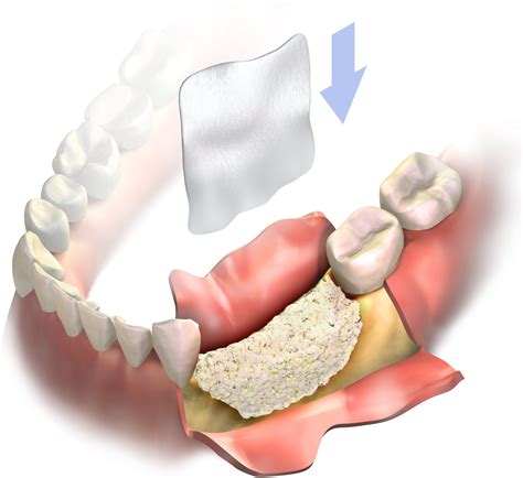 Dental Bone Regeneration - Everything You Need To Know