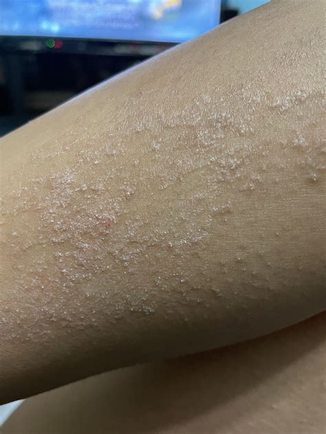 Psoriasis or Dry Skin? Super itchy and spreads the more I scratch. : Skincare_Addiction