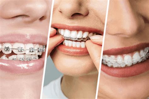clear aligners  metal ceramic braces whats    sabka