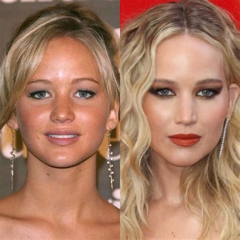 Blake lively s nose job before and after plastic surgery photos – Artofit