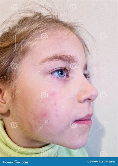 Allergic Rash Dermatitis Eczema Skin On Leg Of Patient. Psoriasis And