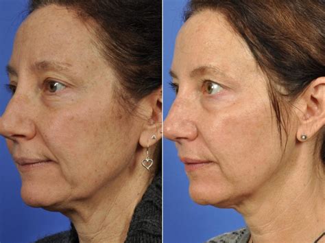 Microneedling Before & After Photos | W Cosmetic Surgery