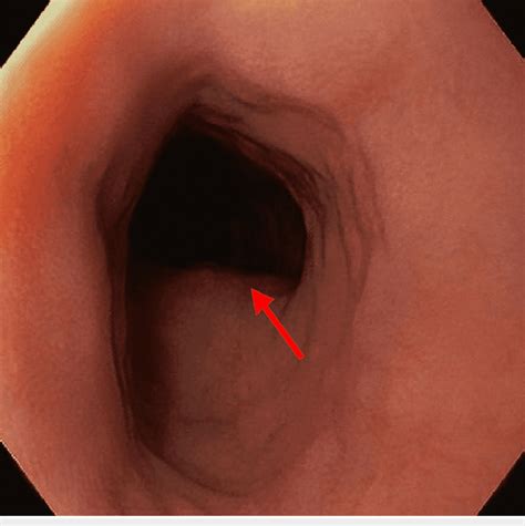 egd showing external compression red arrow posterior   esophagus