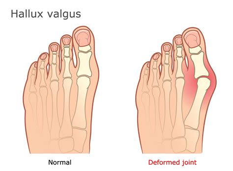 Bunion And Hallux Valgus at Jesse Gisborne blog