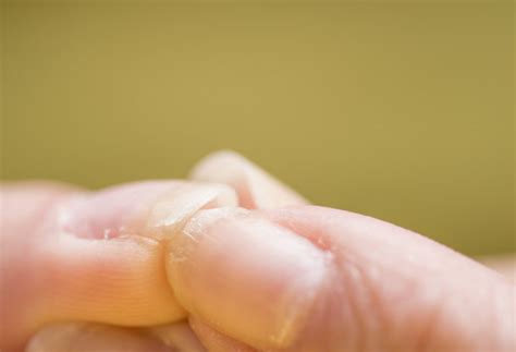 how to fix bitten nails