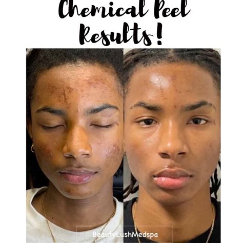 chemical peelsfacials beauty lush medspa