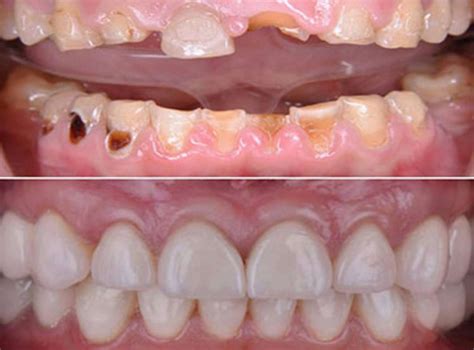 Tooth Decay Treatment Before And After