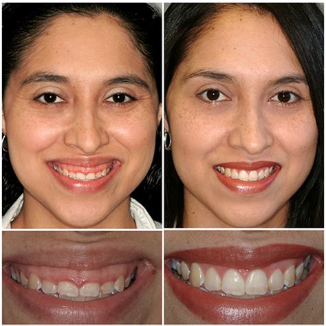 Gengivectomia Antes E Depois