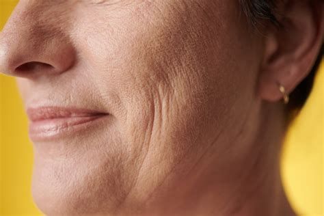 Ozempic Face: The Mysterious Side Effect