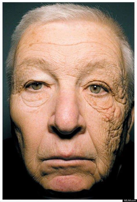 Sun damage on one side of his face caused by 25 years of driving ...