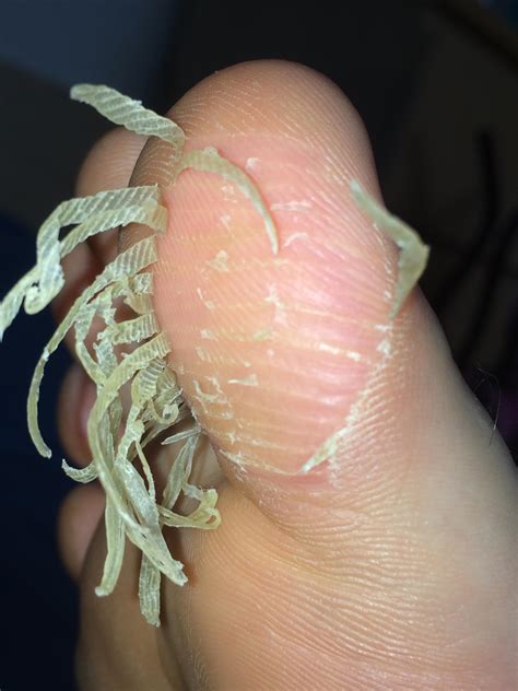 Big toe skin cut/peel : r/peeling