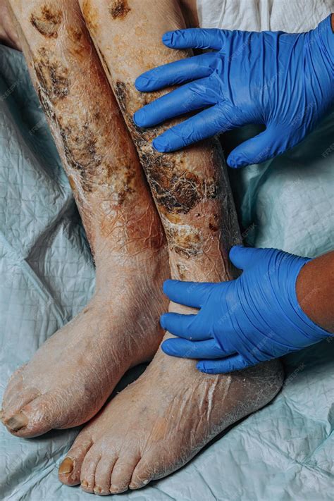 home remedies for swelling legs 7