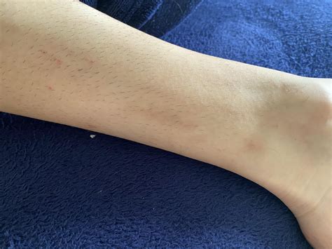 normal   skin bleeds  breaks  easily   scratch