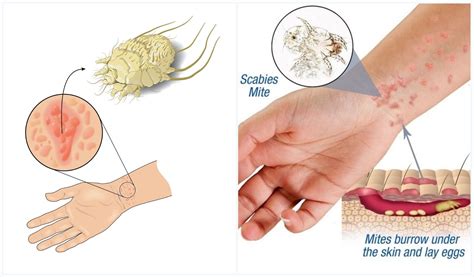 scabies dr kanwal koukab
