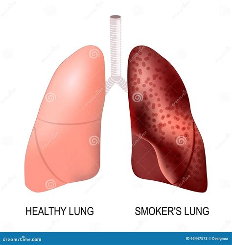 Healthy Lungs and Smokers Lungs Stock Vector - Illustration of lungs