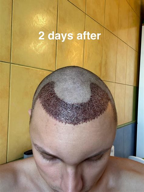 10 days after hair transplant 3